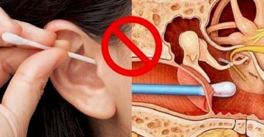 Медики не рекомендуют очищать уши ватными палочками