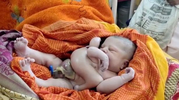 В Индии родился необычный ребенок (ВИДЕО)