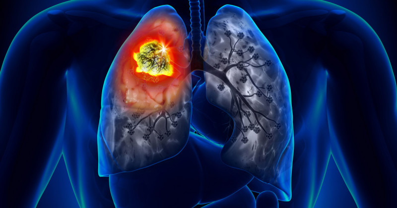 Експерт назвала способи зниження ризику розвитку раку легенів